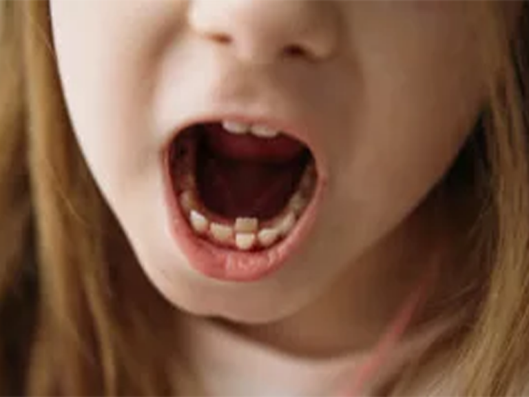 little girl with her mouth open showing a tooth behind another tooth