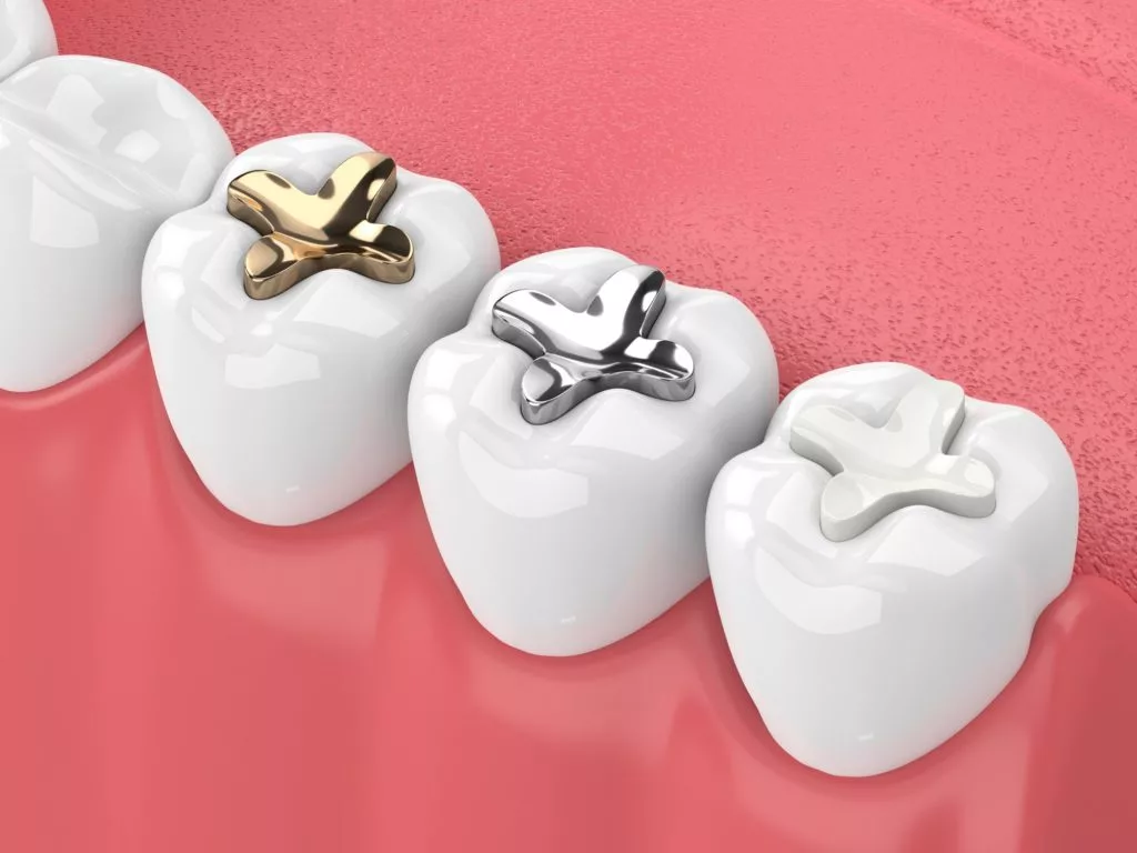 illustration of dental fillings and selants